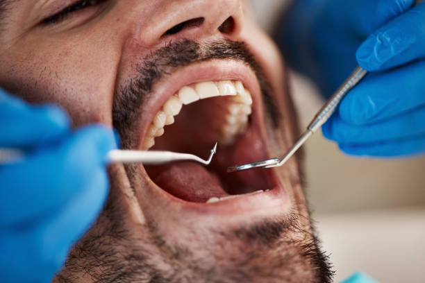 Best Emergency Wisdom Teeth Removal in Rockport, TX